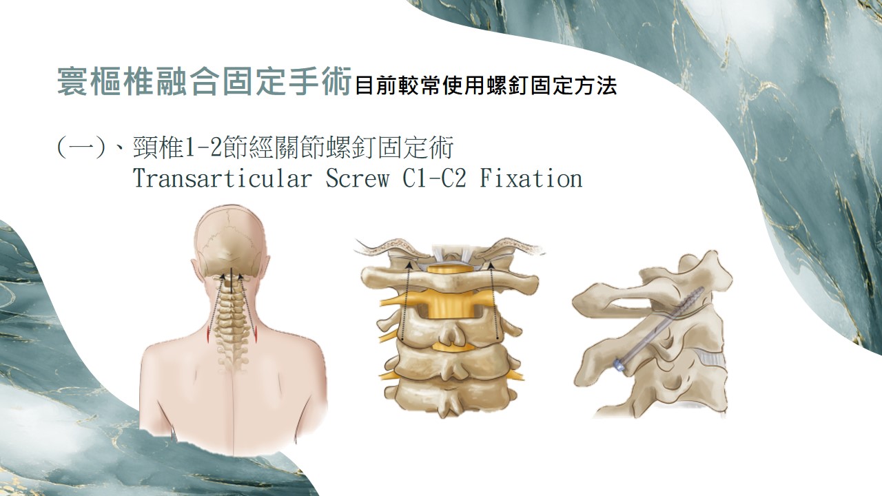 寰樞關節手術示意圖 01
